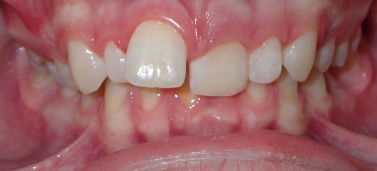 smiles by design orthodontics before and after