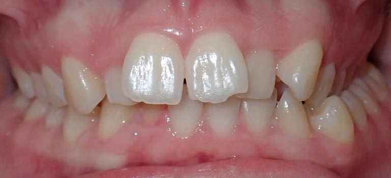 smiles by design orthodontics before and after